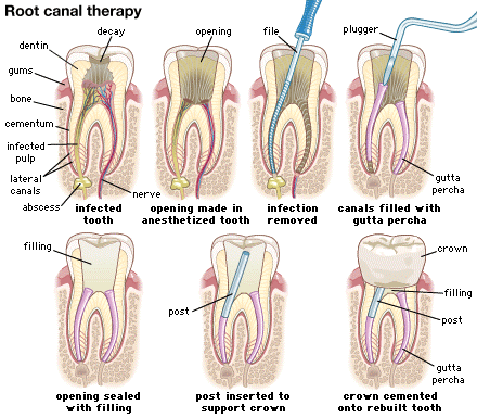 root-canal-process